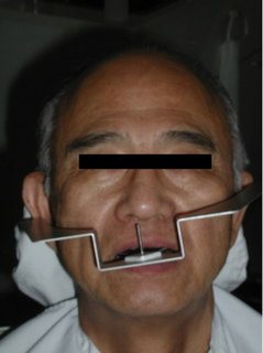 左上がりの咬合平面.jpg